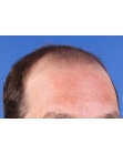 Before Hair Transplant&nbsp;2 Sessions (Areas)